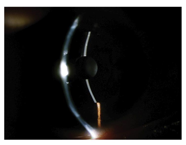 Journal of Cartaract & Refractive Surgery, 41 (2015) 487-491. doi:10.1016/j.jcrs.2015.02.001