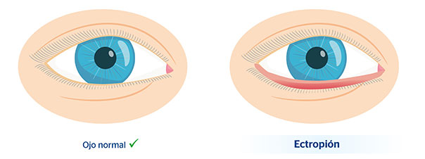 Ojo normal y ojo con ectropin