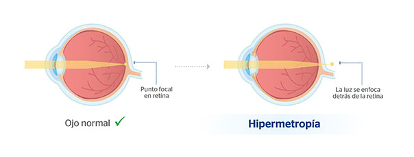 Ojo normal y ojo con hipermetropa