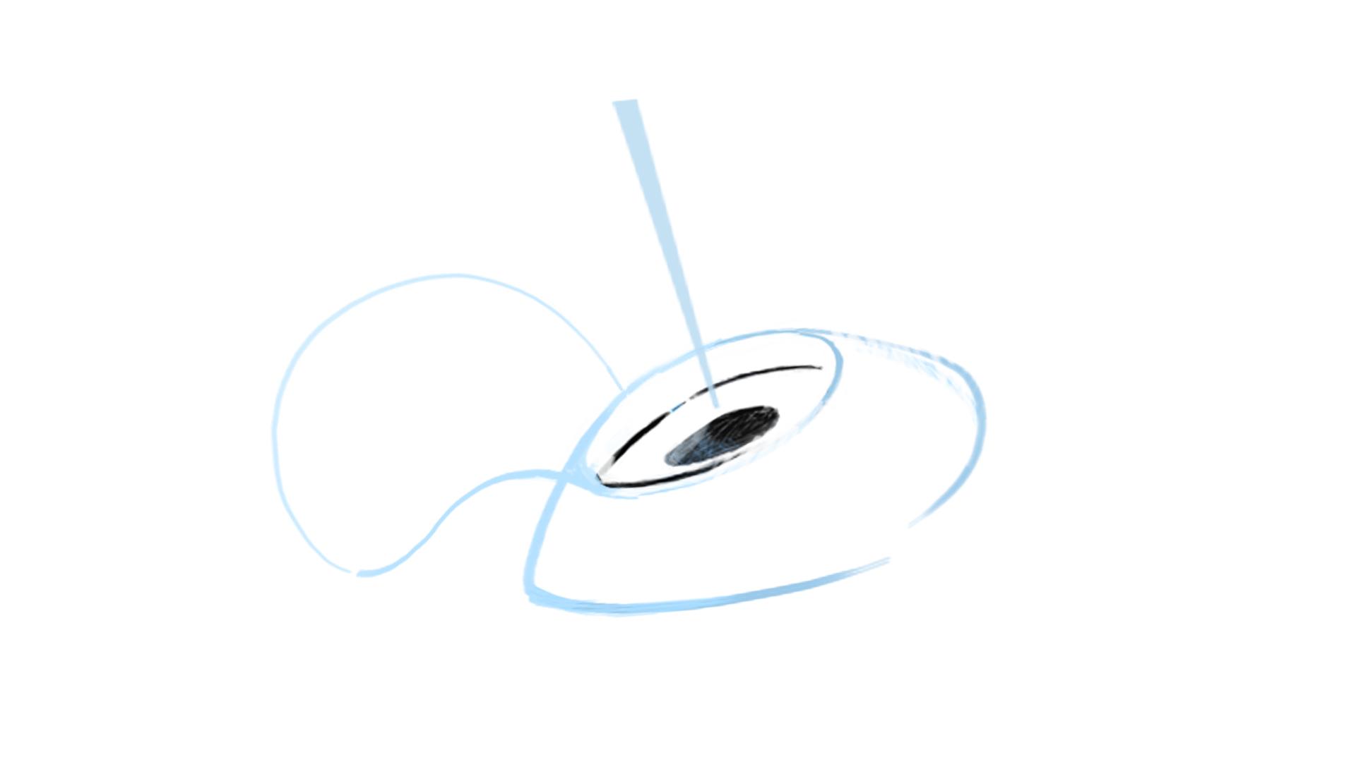 Aplicación del láser en cirugía Lasik