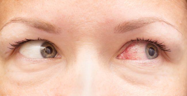 Vision Dark Rings Blood Pressure Vision Dark Rings Blood Pressure