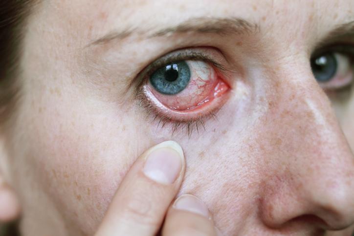 Herpes en la cabeza causas