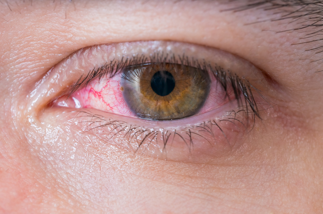 Herpes En El Ojo Todo Sobre Esta Infeccion Ocular Blog De Clinica