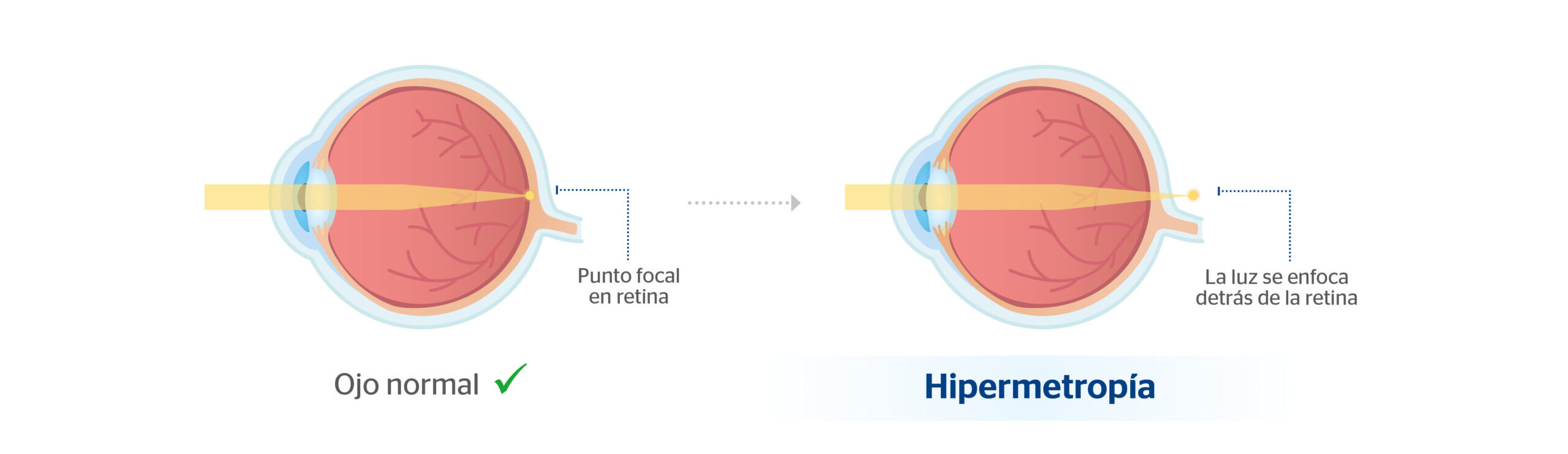 ¿Con qué tipo de lente se corrige la hipermetropía? Blog de Clínica Baviera ¿Con qué tipo de lente se corrige la hipermetropía? Blog de Clínica Baviera