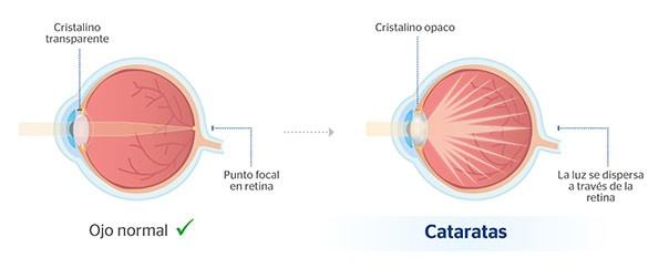 Ojo normal y ojo con cataratas