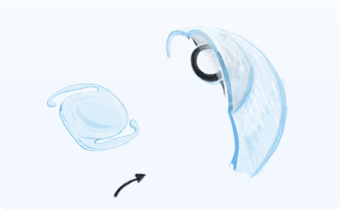 cirugía de cataratas