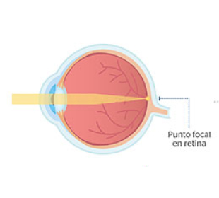 ojo normal sin cataratas