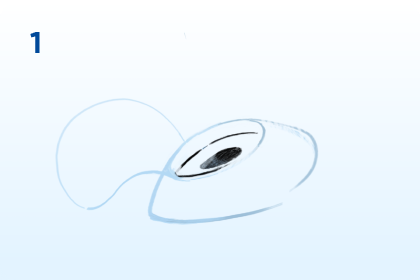 paso 1 cirugía Lasik