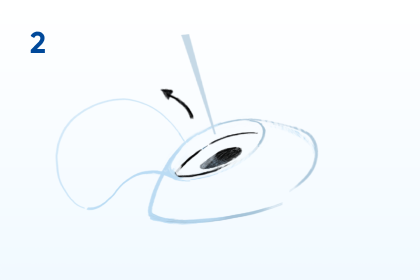 paso 2 cirugía Lasik