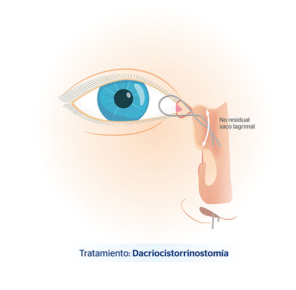 En qu consiste la dacriocitorrinostoma