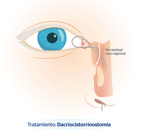 En qu consiste la dacriocitorrinostoma