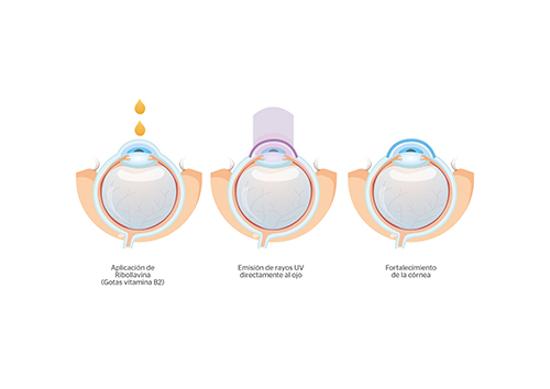 crosslinking corneal