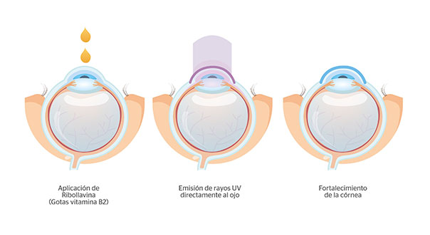 En qu consiste el crosslinking corneal