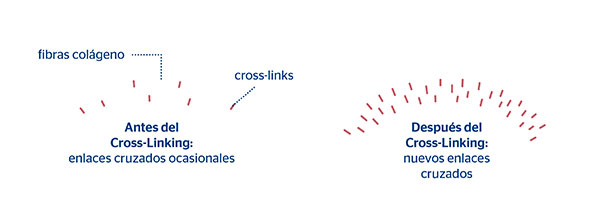 Resultados del crosslinking corneal