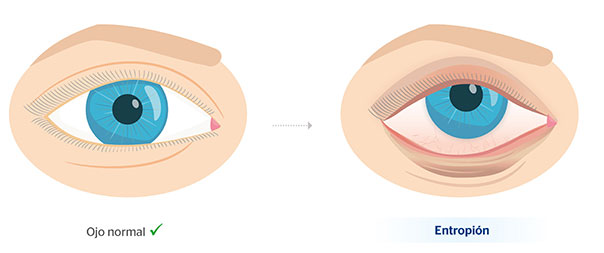 Ojo normal y ojo con entropin