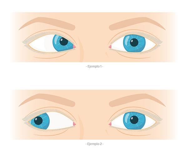 Tipos de estrabismo