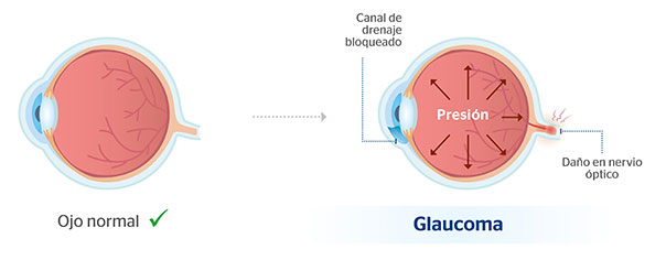  Ojo normal y ojo con glaucoma