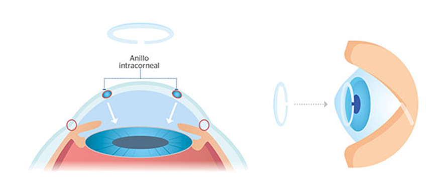 esquema anillo intracorneal