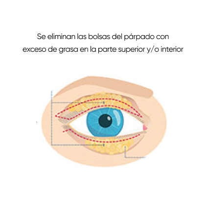 cirugía de blefaroplastia