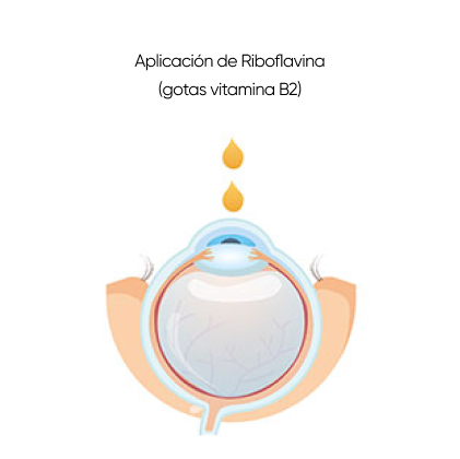 crosslinking corneal aplicación de rivoflamina