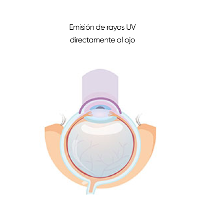 crosslinking corneal emisión de rayos UV