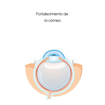 resultados tras crossliking corneal