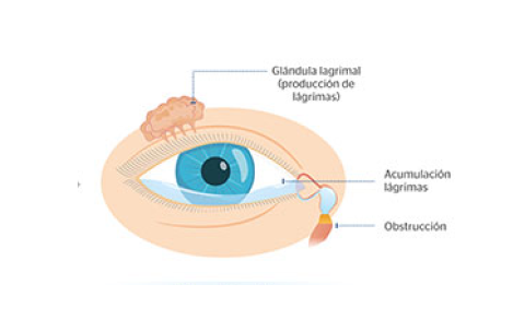 ojo con obstrucción de las vías lagrimales
