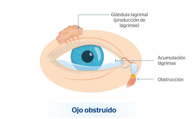 hombre maduro frotándose un ojo