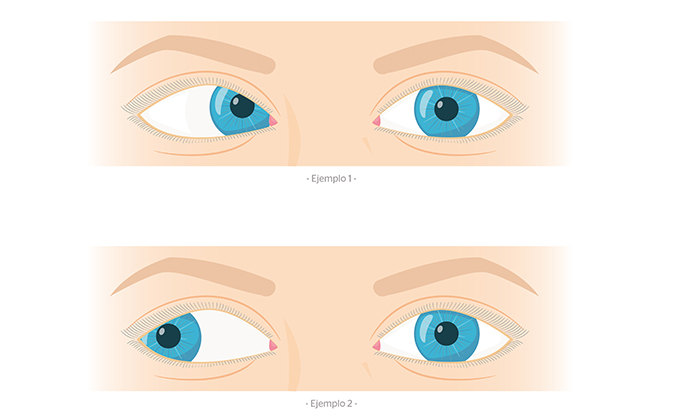 Ejemplos de estrabismo