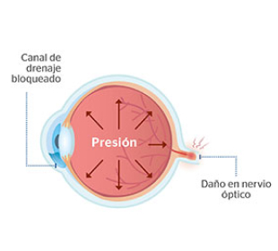 ojo con glaucoma