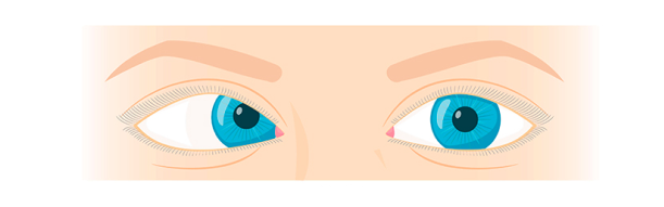 estrabismo convergente