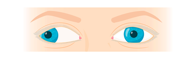 estrabismo divergente