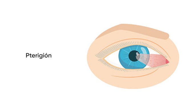 ojo con pterigión