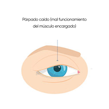 ojo con ptosis palpebral