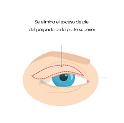 cirugía de ptosis