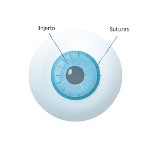 resultados tras un trasplante de córnea