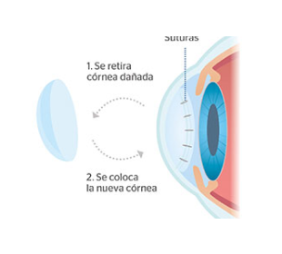 cómo se hace un trasplante de córnea