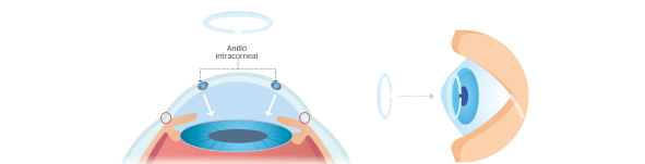 implante de anillos intracorneales con láser