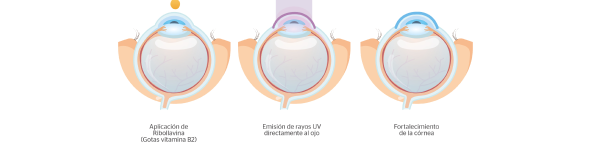 crosslinking corneal