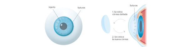 trasplante de córnea
