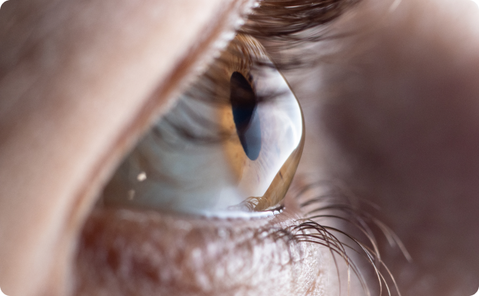 primer plano ojo con queratocono de perfil