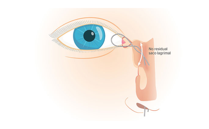 dacriocistorrinostomía
