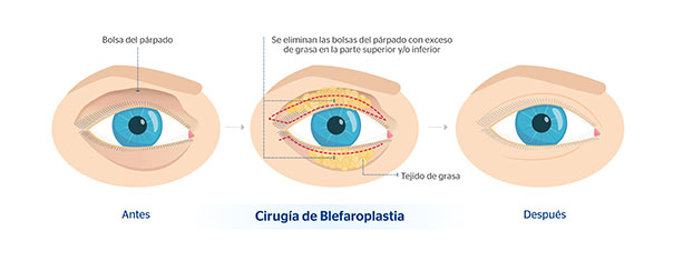 En qu consiste la blefaroplastia