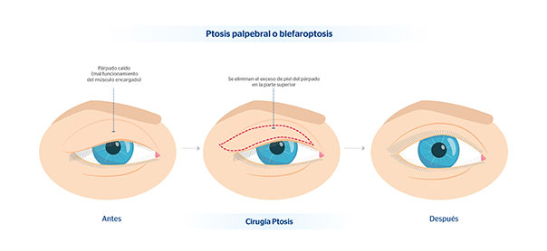 En qu consiste la ciurga de la ptosis