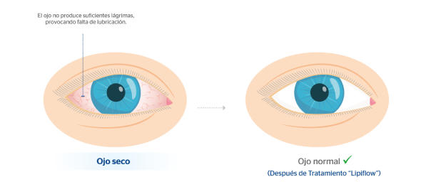 Cmo ve un paciente con ojo seco