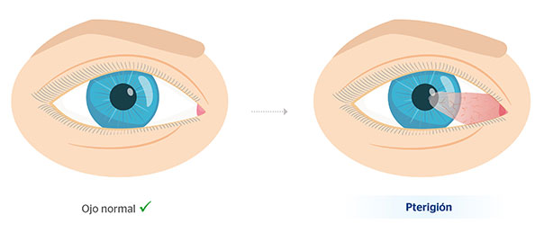 Ojo normal y ojo con pterigin