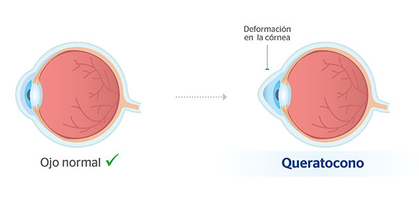 negativ oftalmologie