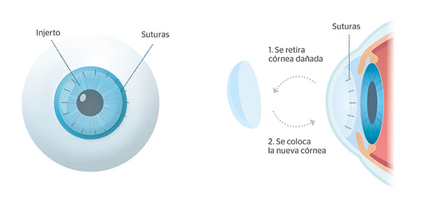 En qu consiste el trasplante de crnea o queratoplastia