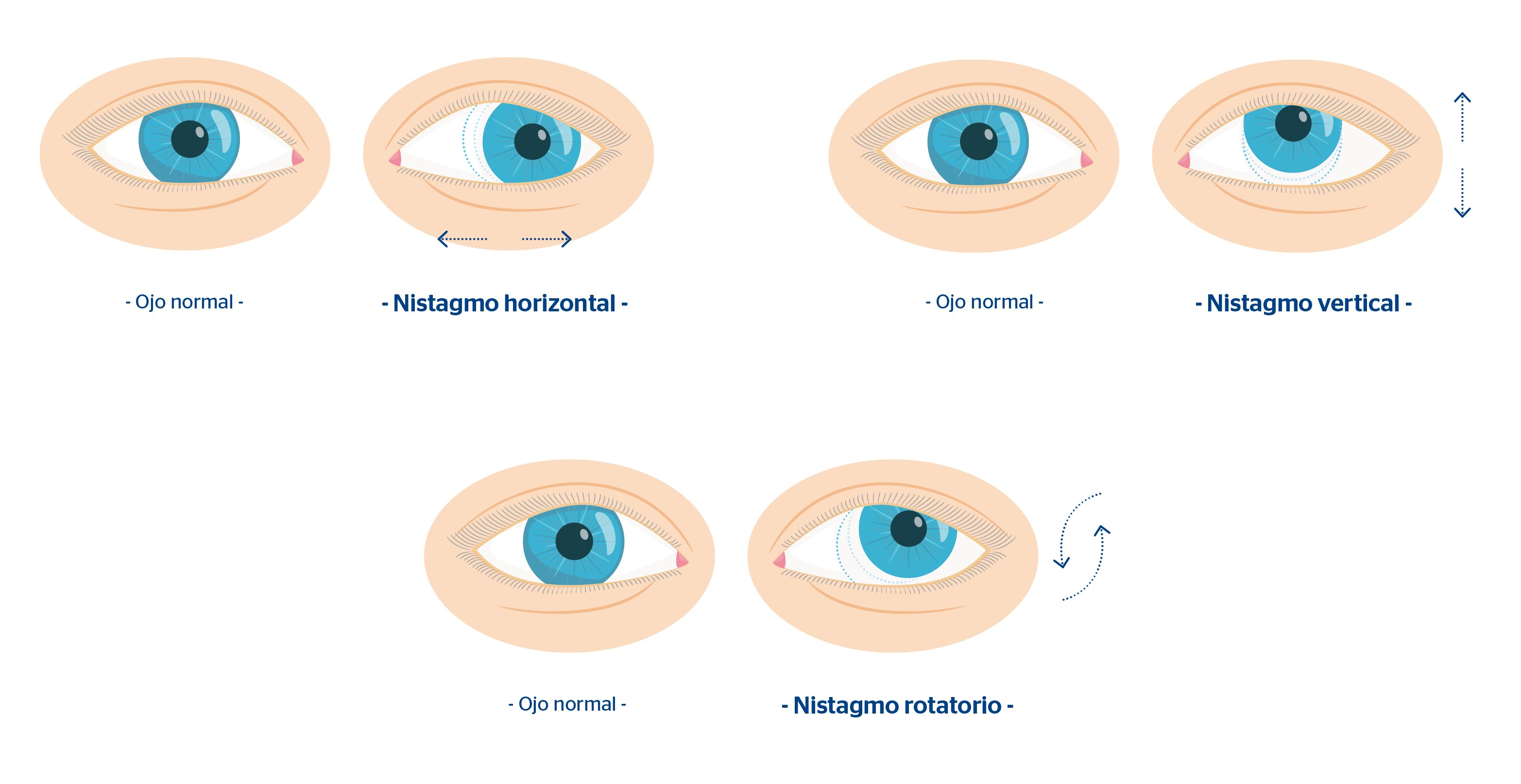 tipos de nistagmus