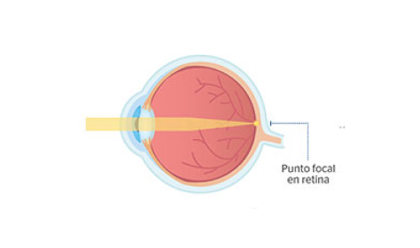 ojo normal sin presbicia